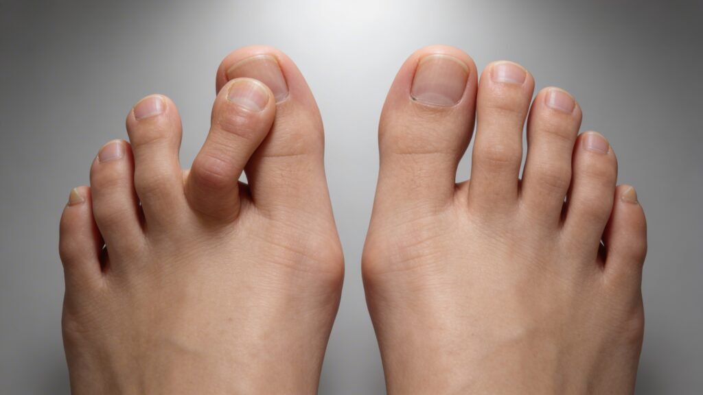 Overlapping Toe - General Hospital